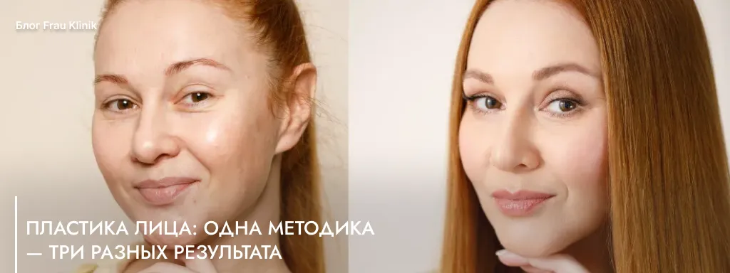 Пластика лица: одна методика — три разных результата