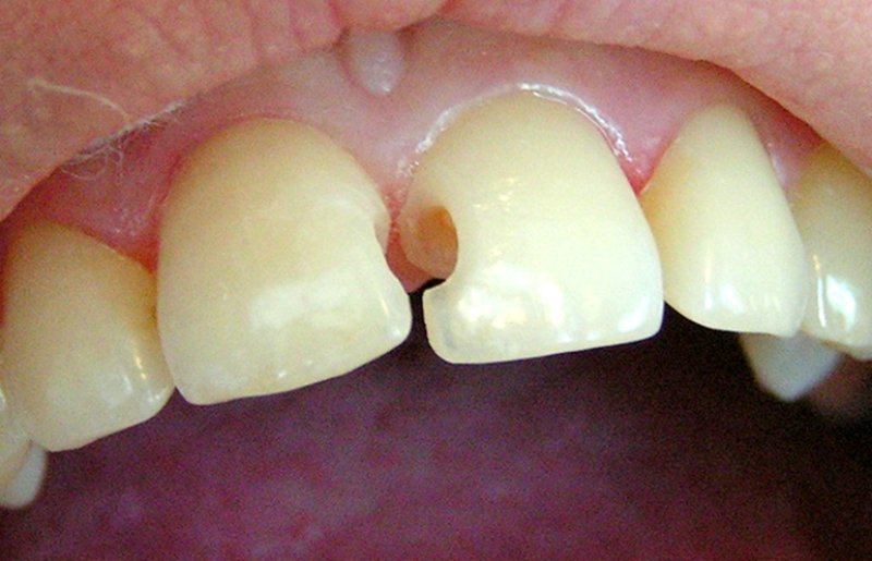 Лечение дырки в зубе как называется