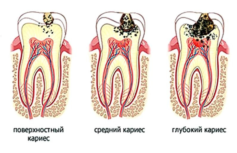 Лечение дырки в зубе как называется
