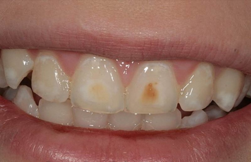 Возникновение дырок в зубах: причины