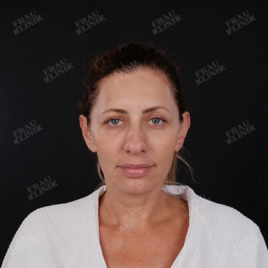 Фейслифтинг