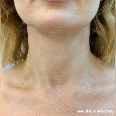 Ботулотоксин