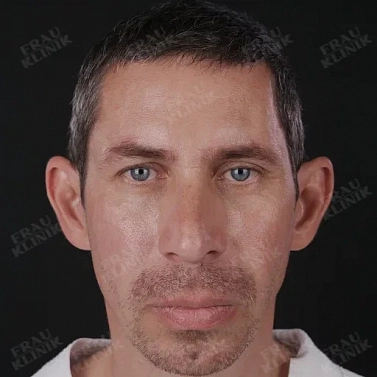 Пластика ушей