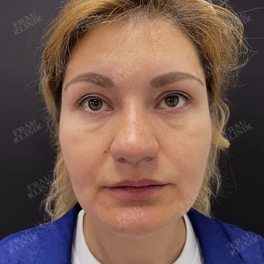 Ботокс и контурная пластика