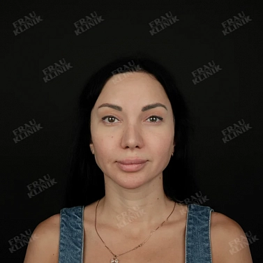 Височный лифтинг