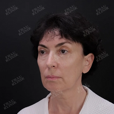 Фейслифтинг и блефаропластика