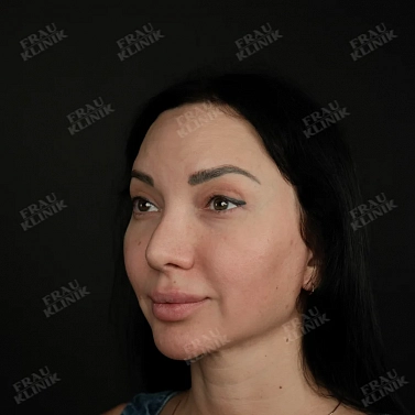 Височный лифтинг