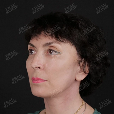 Фейслифтинг и блефаропластика