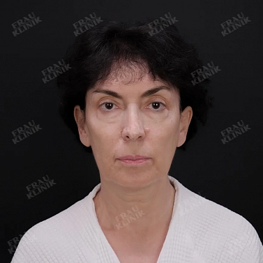 Фейслифтинг и блефаропластика