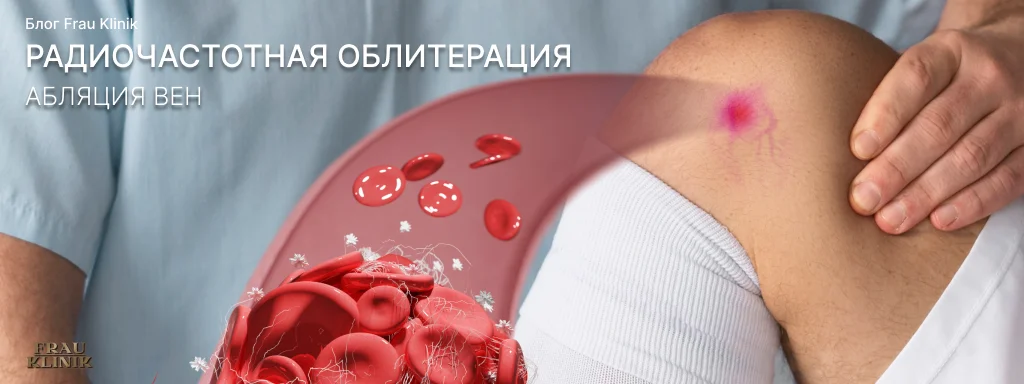 Радиочастотная облитерация (абляция) вен
