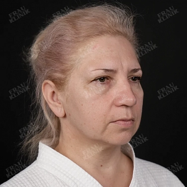 Фейслифтинг