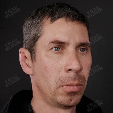 Пластика ушей