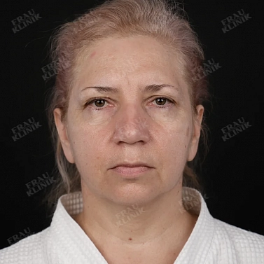 Фейслифтинг