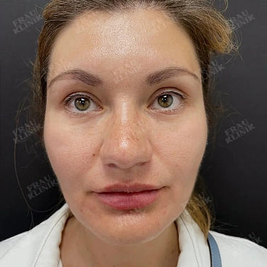 Ботокс и контурная пластика