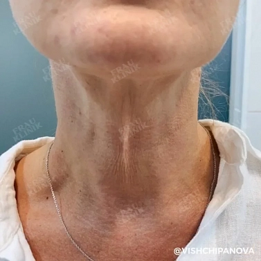 Ботулотоксин