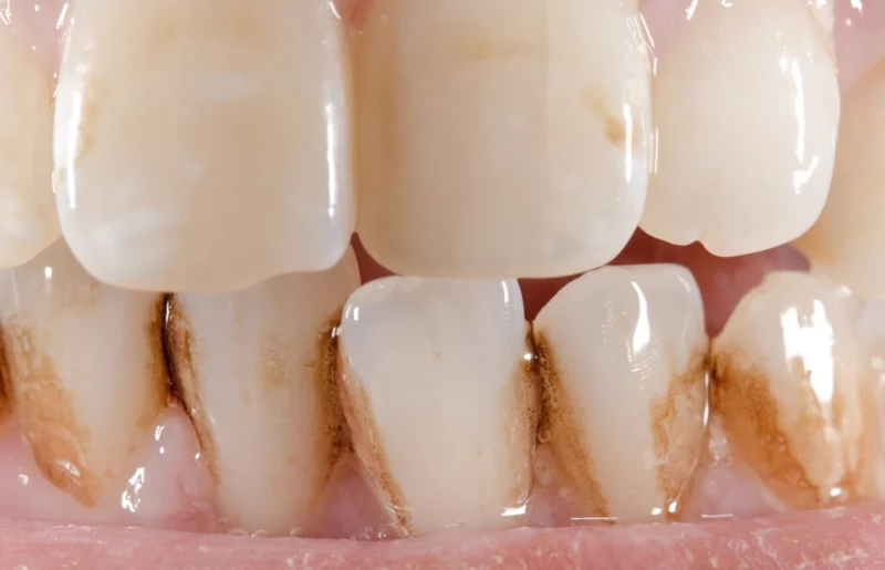 Удаляем зубной налет — советы стоматолога